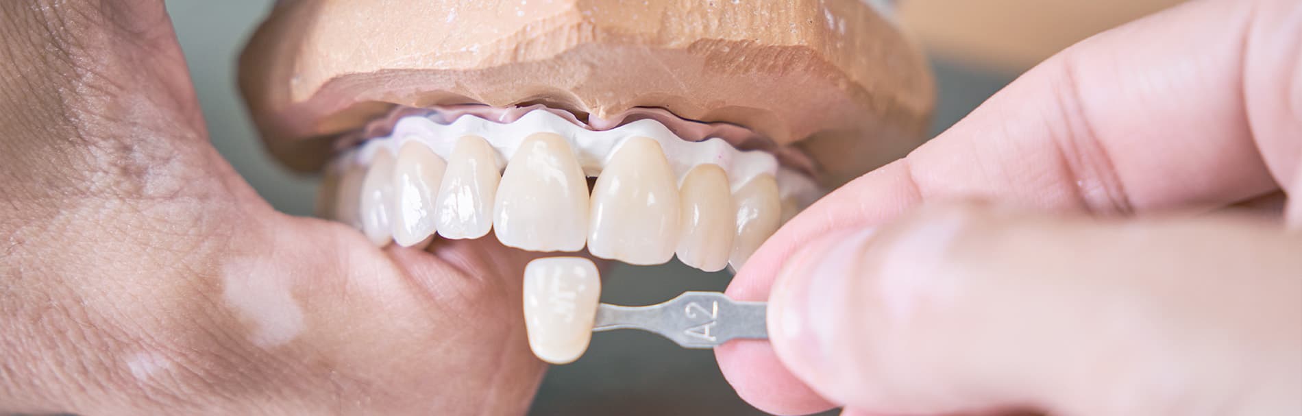 Vervanging kunstgebit